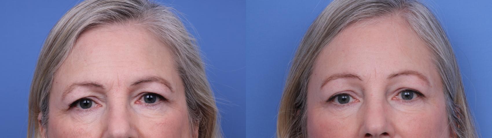 Before & After Facelift Case 654 Zoom Brow View in Scottsdale, AZ