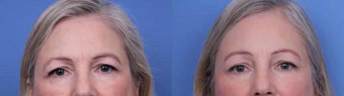 Facelift Before & After Photo | Scottsdale & Phoenix, AZ | Hobgood Facial Plastic Surgery: Todd Hobgood, MD