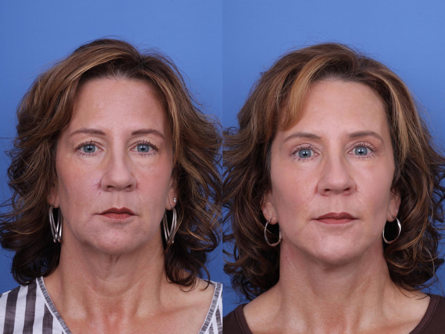 Before & After Facelift Case 656 Front View in Scottsdale, AZ