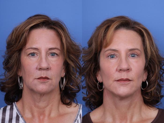 Before & After Facelift Case 656 Front View in Scottsdale, AZ
