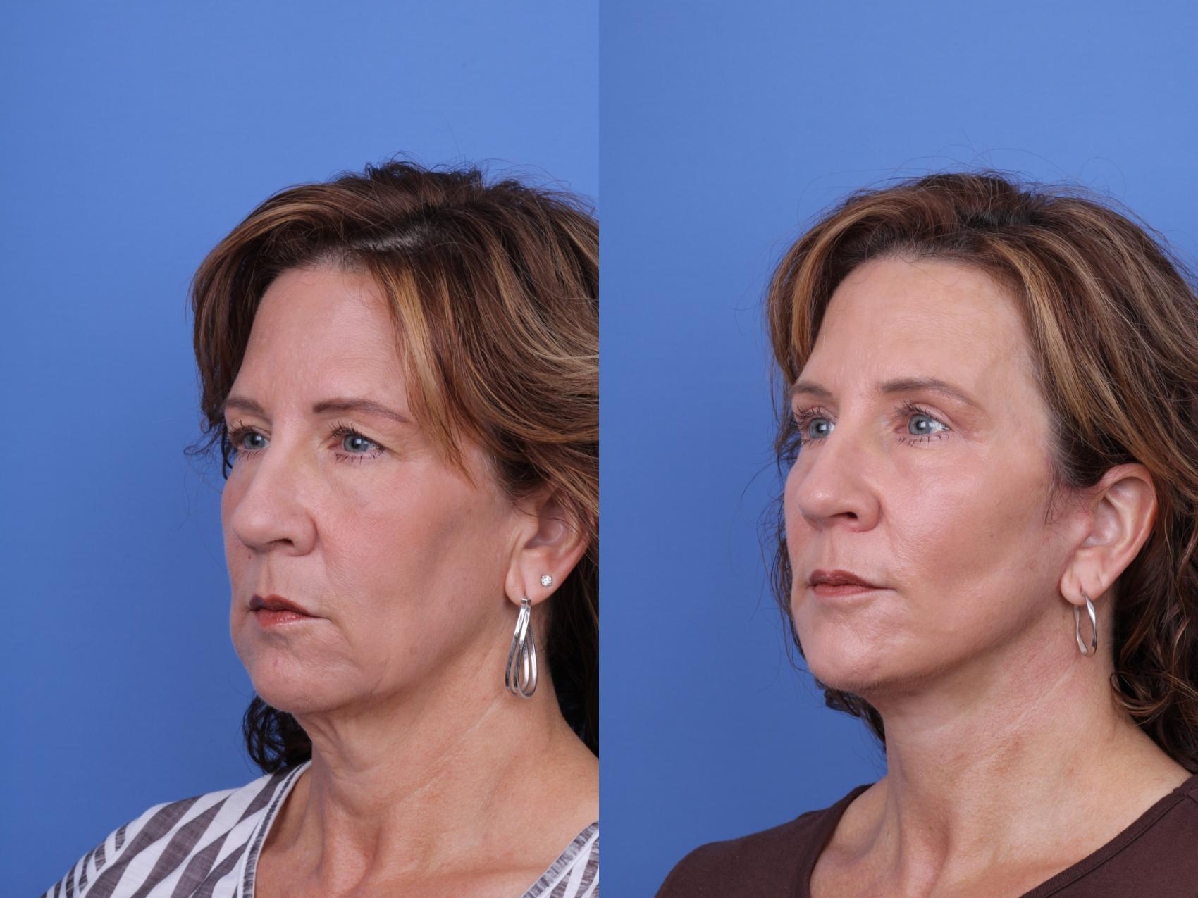 Before & After Facelift Case 656 Left Oblique View in Scottsdale, AZ