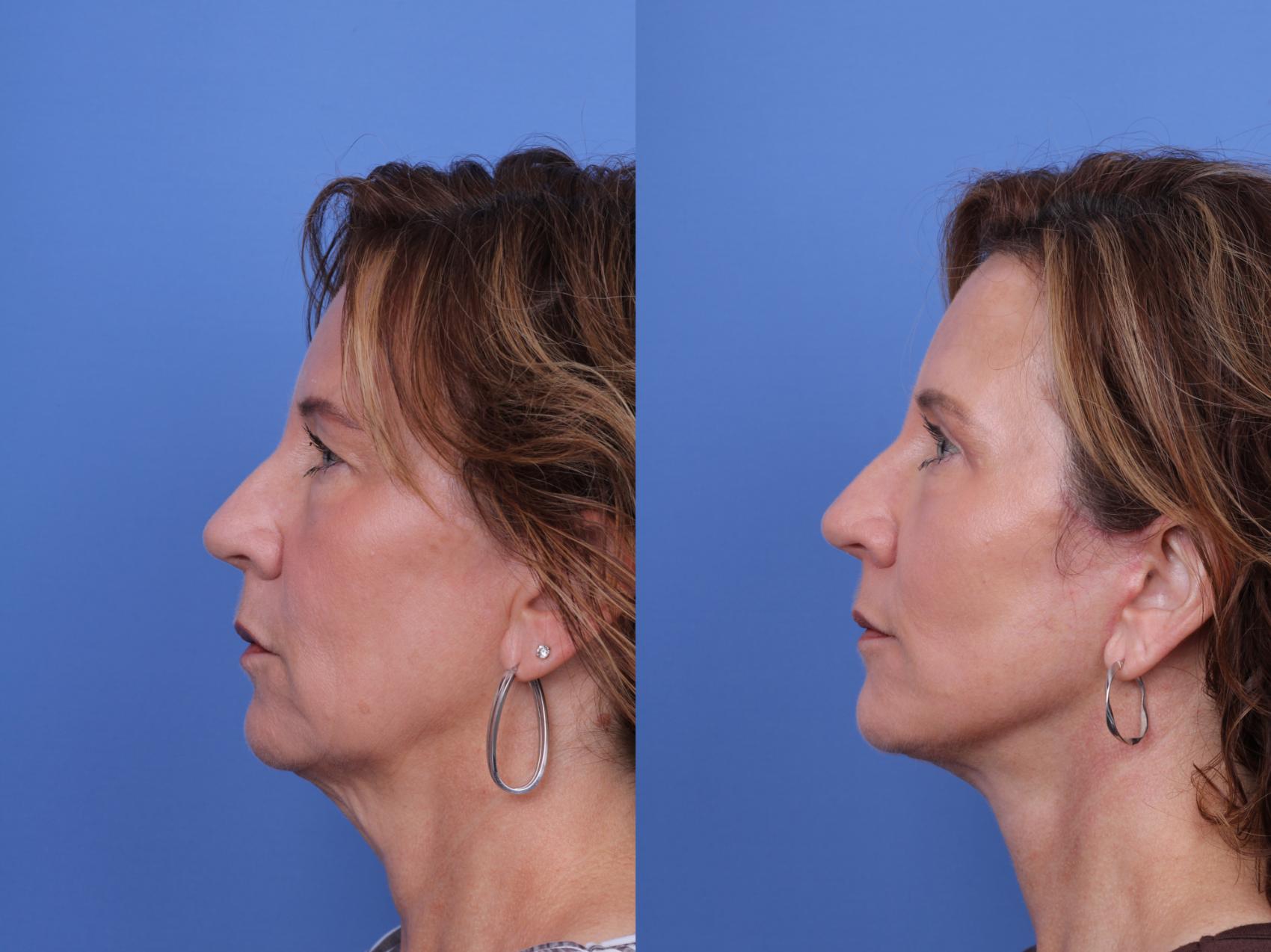 Before & After Facelift Case 656 Left Side View in Scottsdale, AZ