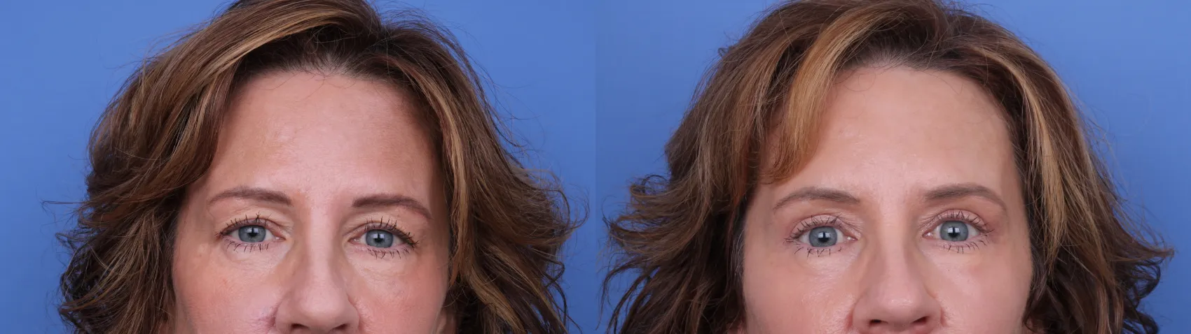 Facelift Before and After Pictures Case 656 | Scottsdale, AZ Facelift Before and After Pictures Case 656 | Scottsdale, AZ