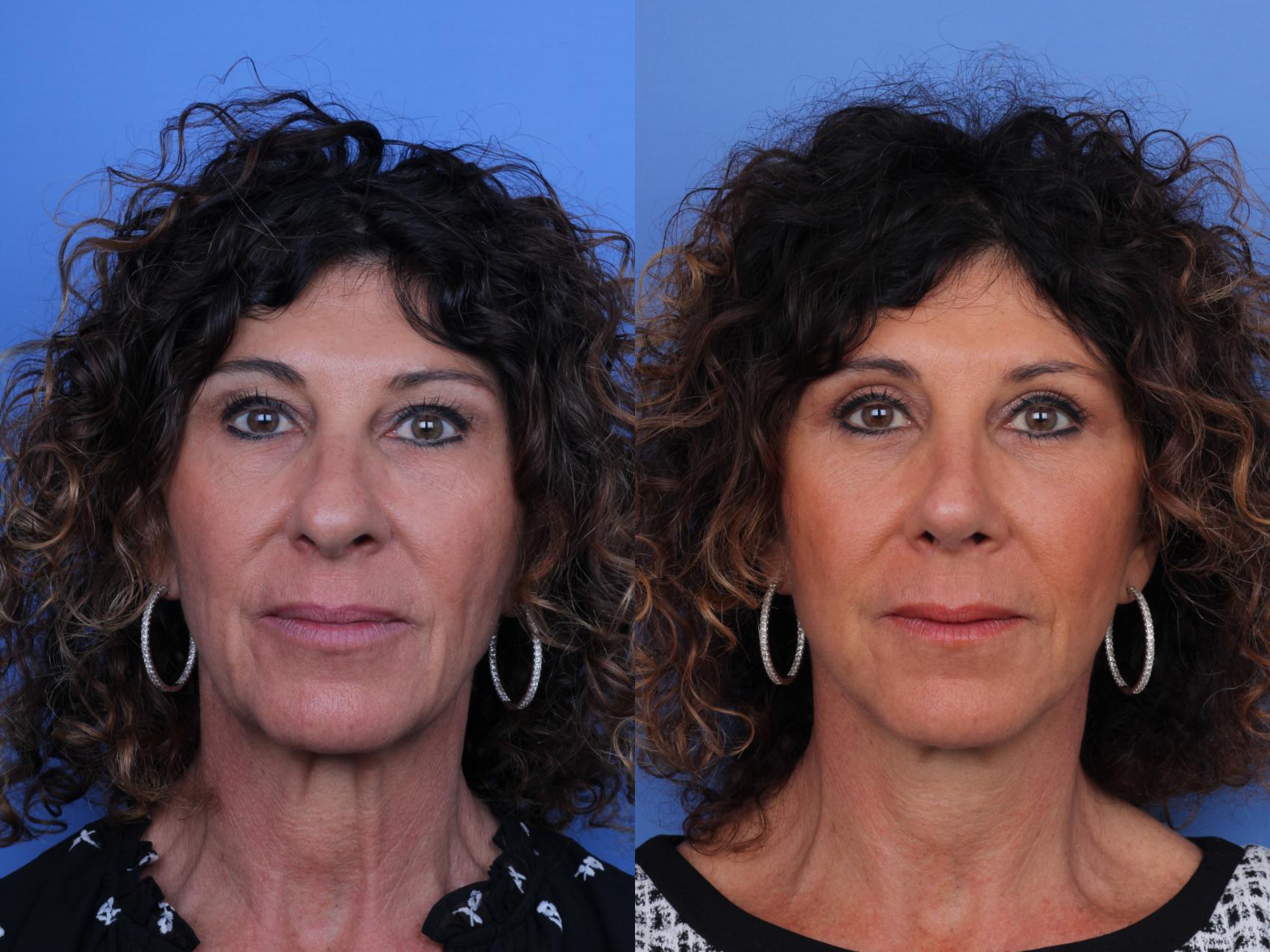 Before & After Rhinoplasty Case 657 Front View in Scottsdale, AZ