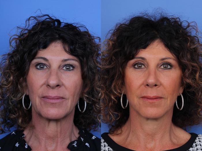 Before & After Rhinoplasty Case 657 Front View in Scottsdale, AZ