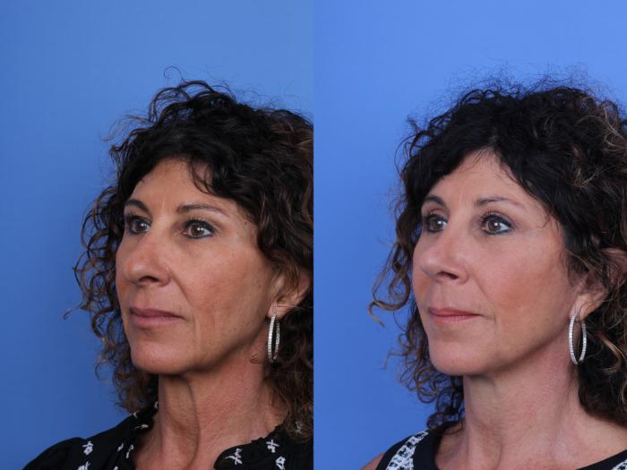 Before & After Rhinoplasty Case 657 Left Oblique View in Scottsdale, AZ