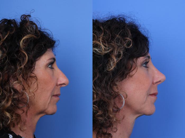 Before & After Rhinoplasty Case 657 Right Side View in Scottsdale, AZ