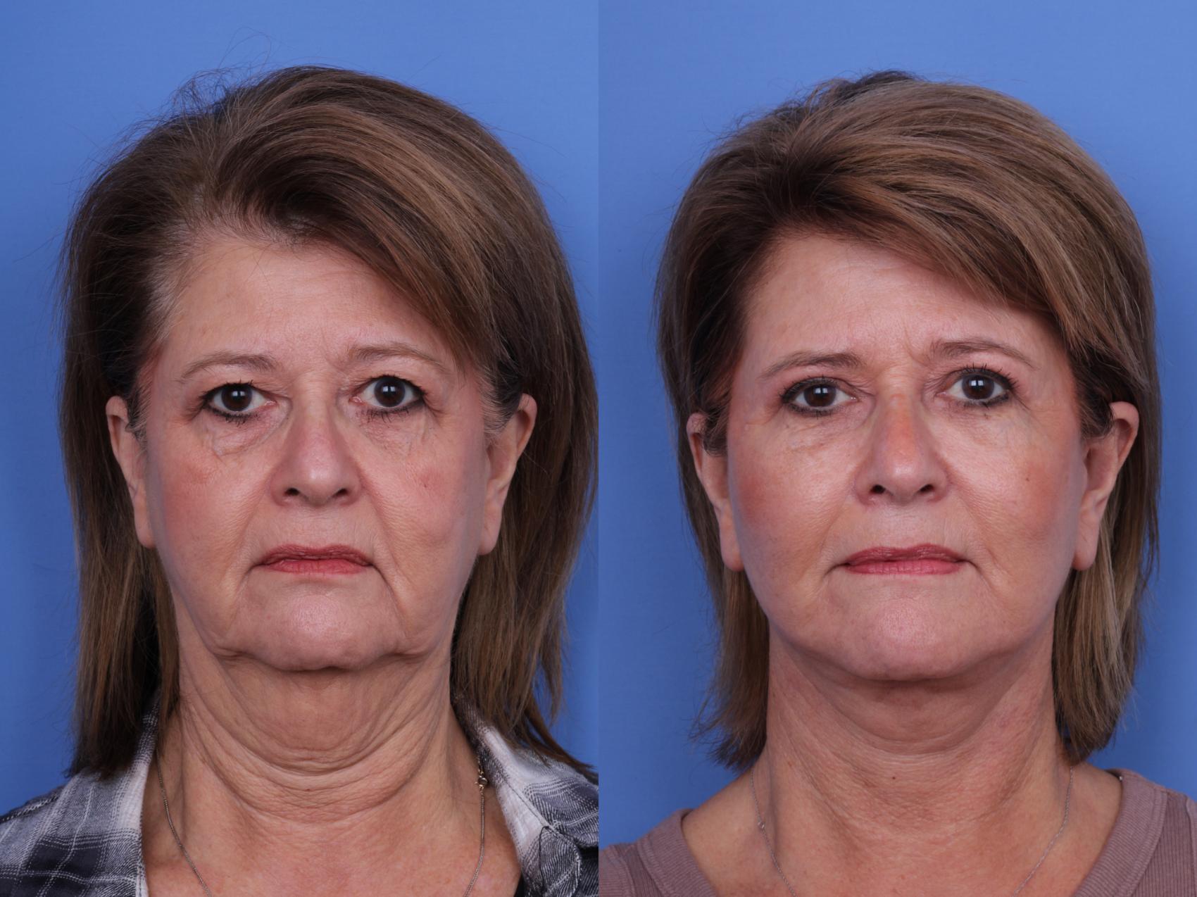 Before & After Blepharoplasty Case 658 Front View in Scottsdale, AZ