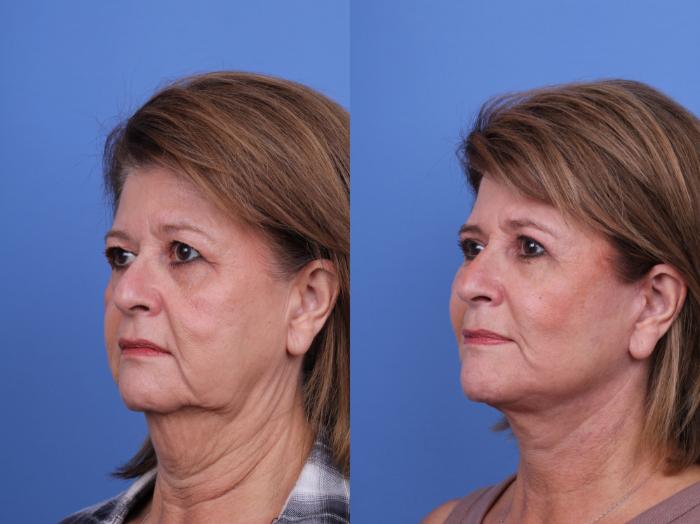 Before & After Blepharoplasty Case 658 Left Oblique View in Scottsdale, AZ