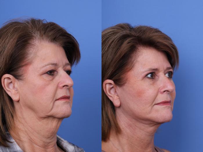 Before & After Blepharoplasty Case 658 Right Oblique View in Scottsdale, AZ