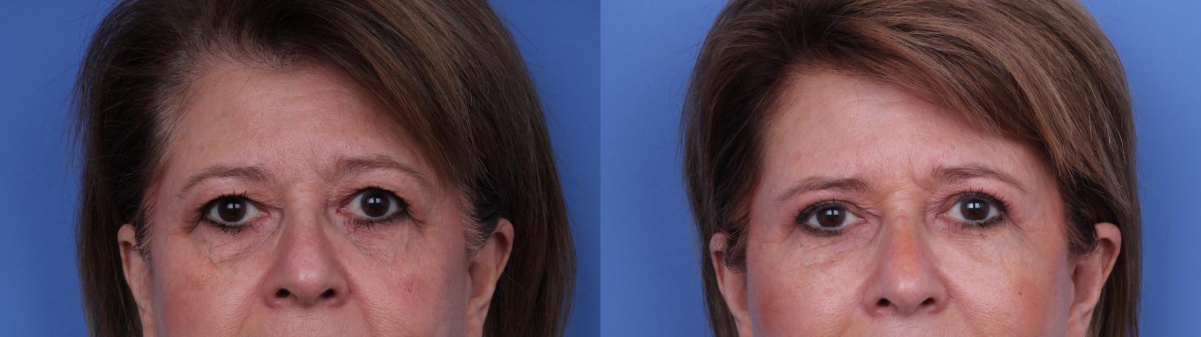 Before & After Blepharoplasty Case 658 Zoom Blepharoplasty View in Scottsdale, AZ