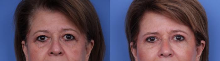 Before & After Blepharoplasty Case 658 Zoom Blepharoplasty View in Scottsdale, AZ