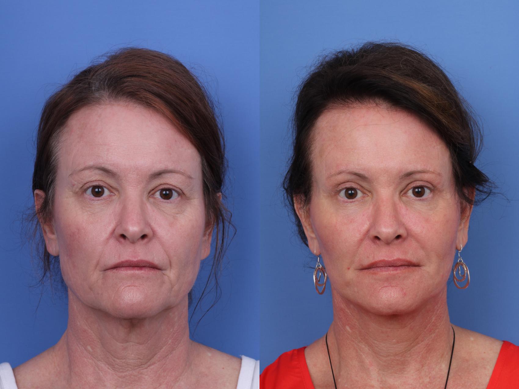 Before & After Facelift Case 662 Front View in Scottsdale, AZ