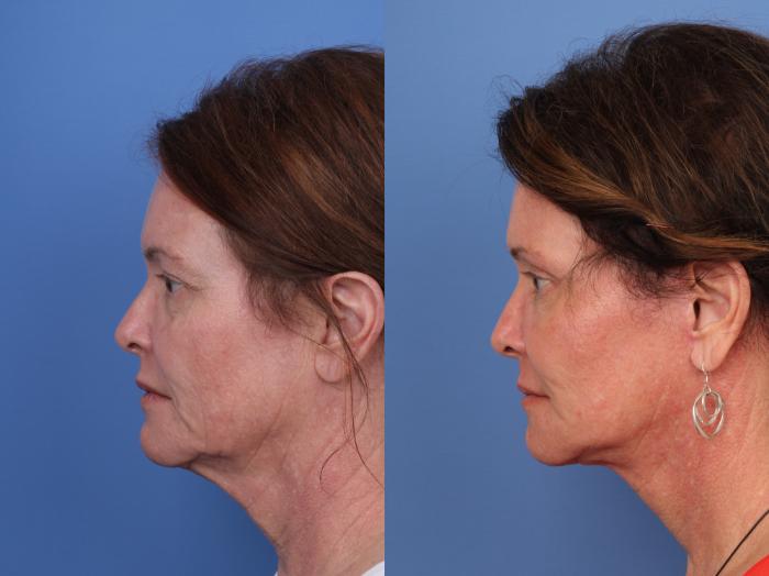 Facelift Before and After Pictures Case 662 | Scottsdale, AZ