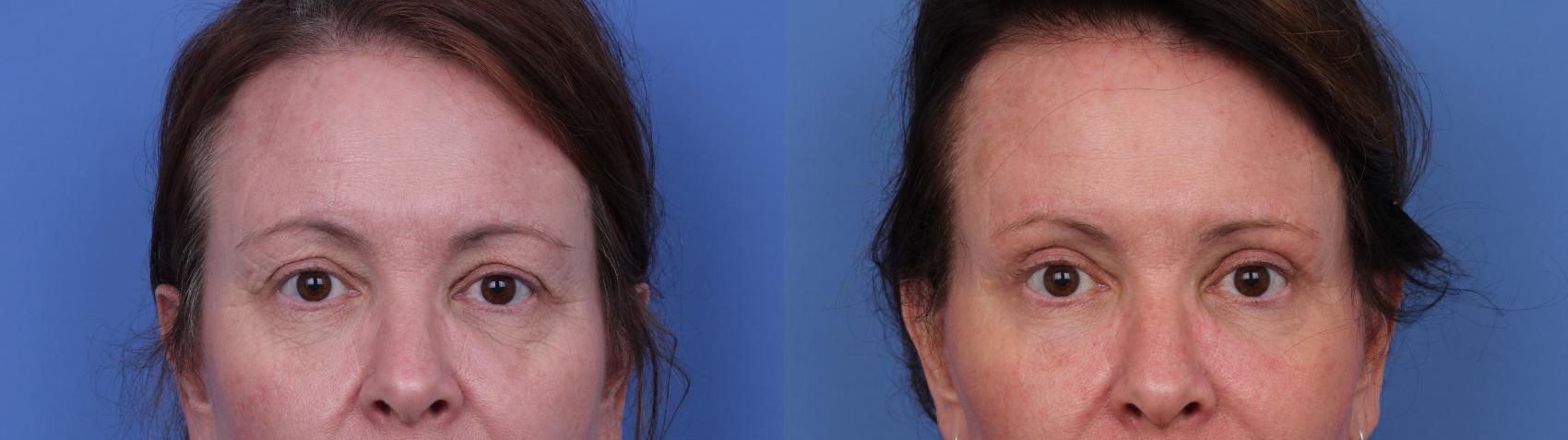 Before & After Facelift Case 662 Zoom Blepharoplasty View in Scottsdale, AZ