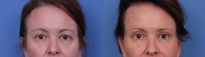 Before & After Facelift Case 662 Zoom Blepharoplasty View in Scottsdale, AZ