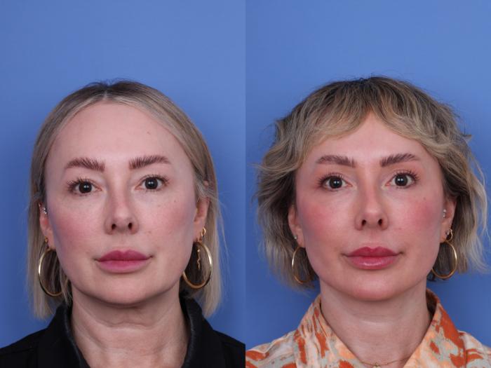 Before & After Facelift Case 663 Front View in Scottsdale, AZ
