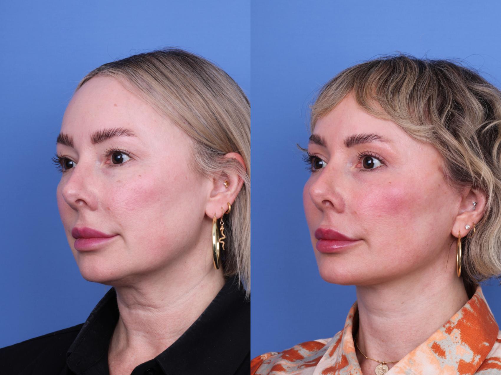 Before & After Facelift Case 663 Left Oblique View in Scottsdale, AZ