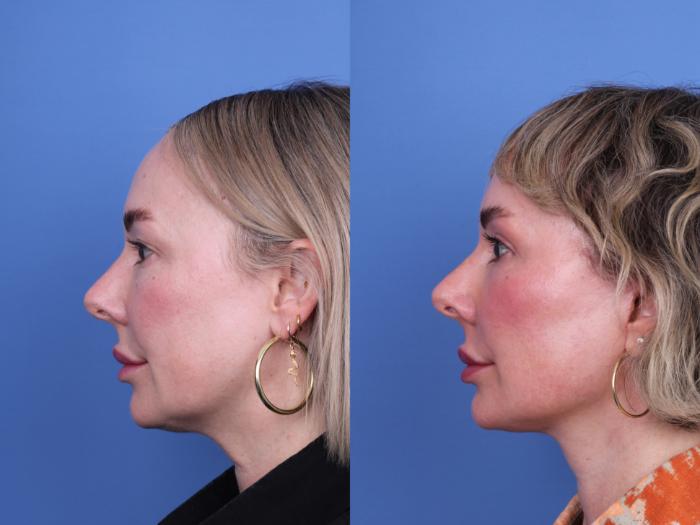 Before & After Facelift Case 663 Left Side View in Scottsdale, AZ