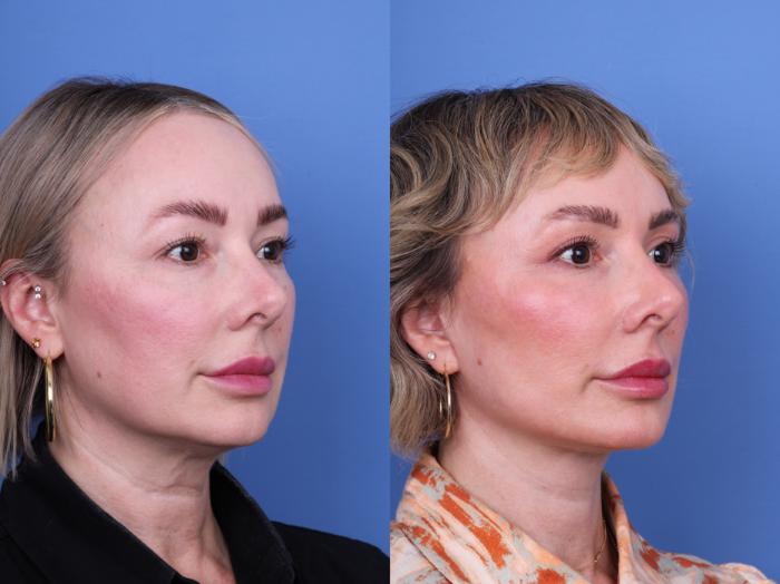 Before & After Facelift Case 663 Right Oblique View in Scottsdale, AZ