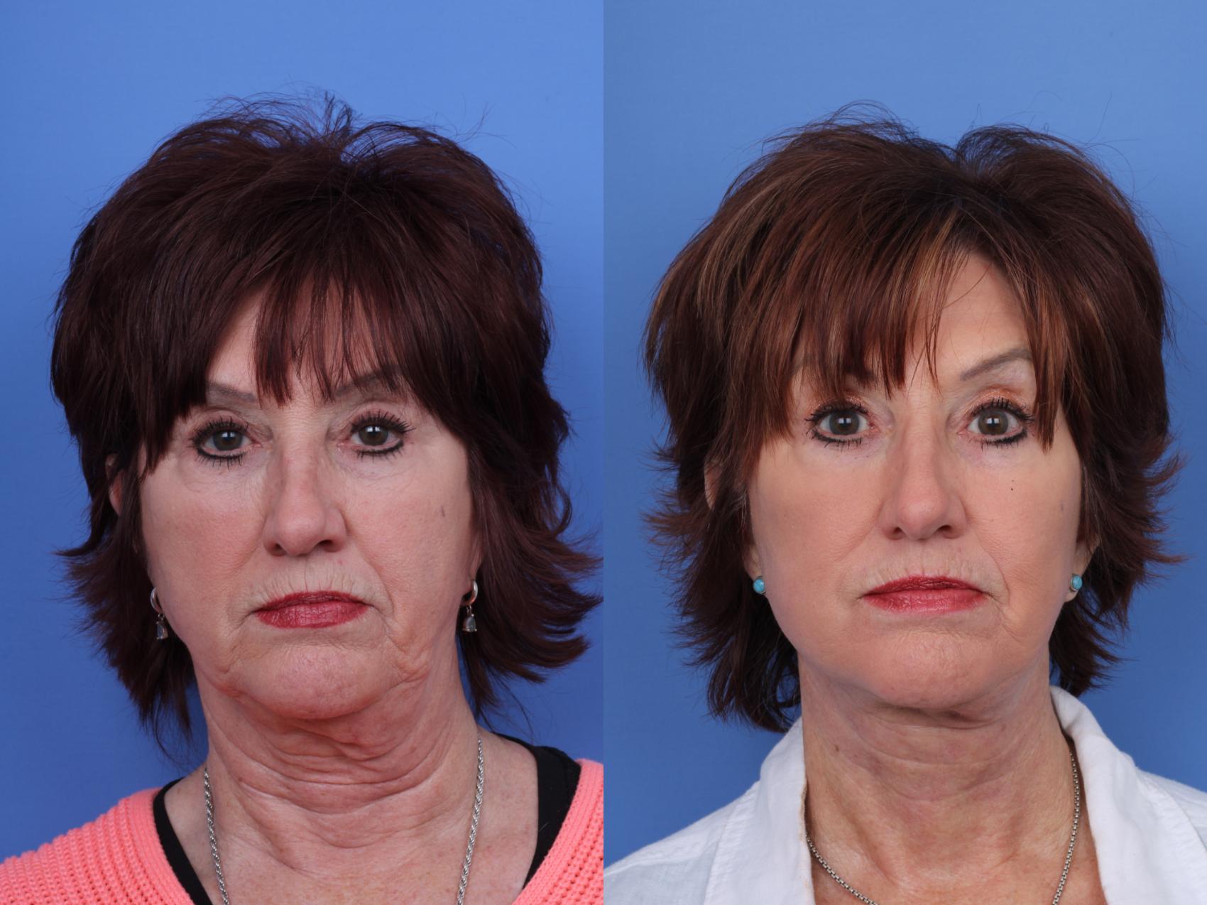 Before & After Facelift Case 671 Front View in Scottsdale, AZ