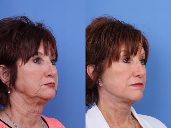 Before & After Facelift Case 671 Right Oblique View in Scottsdale, AZ