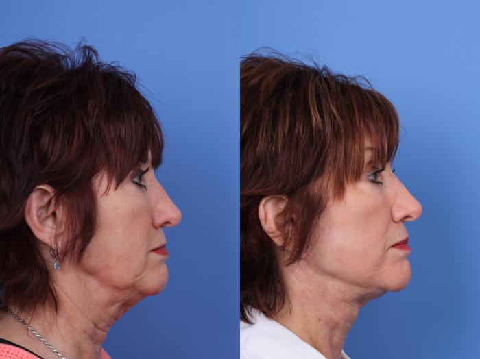 Before & After Facelift Case 671 Right Side View in Scottsdale, AZ