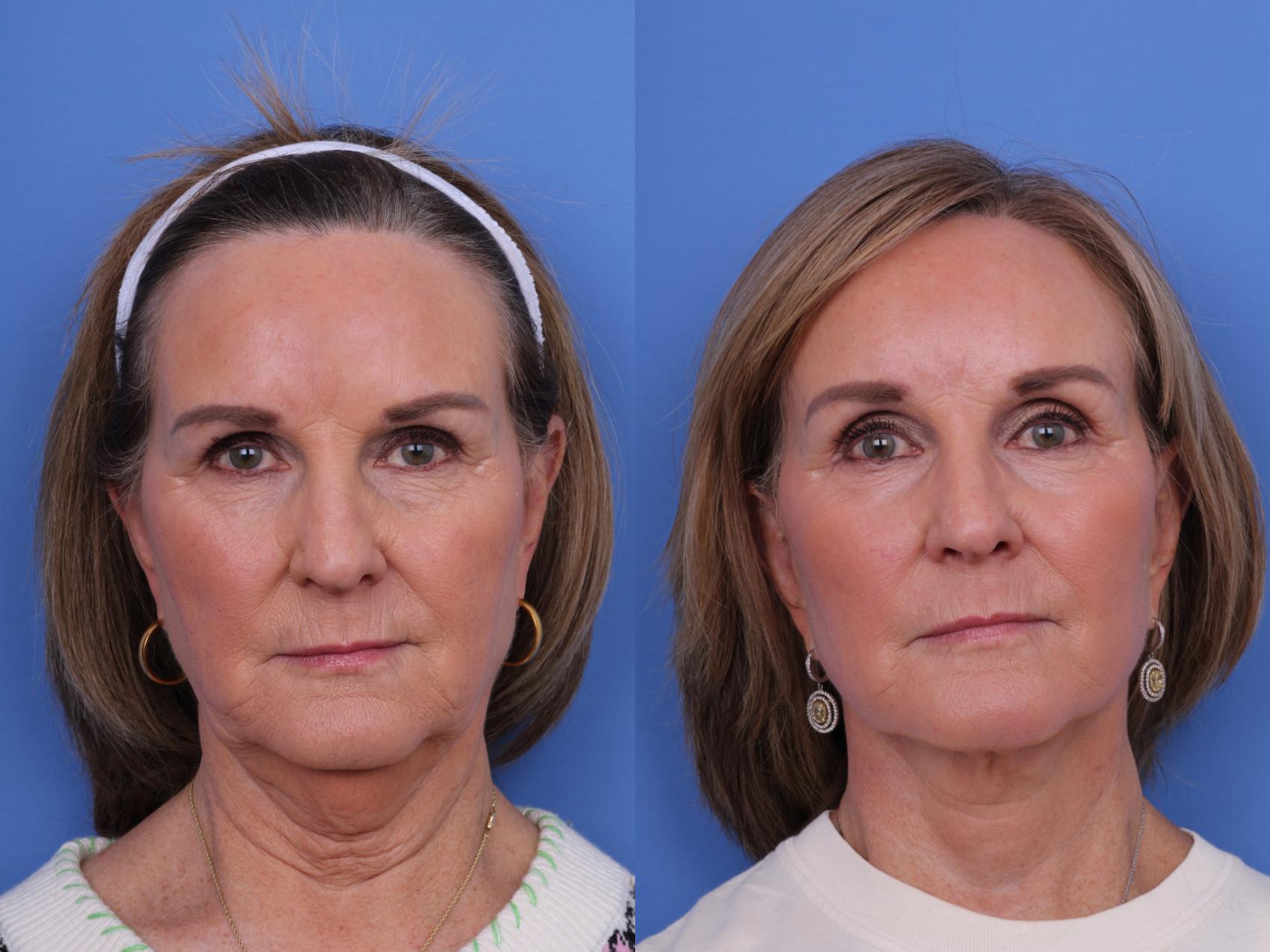 Before & After Brow Lift Case 673 Front View in Scottsdale, AZ
