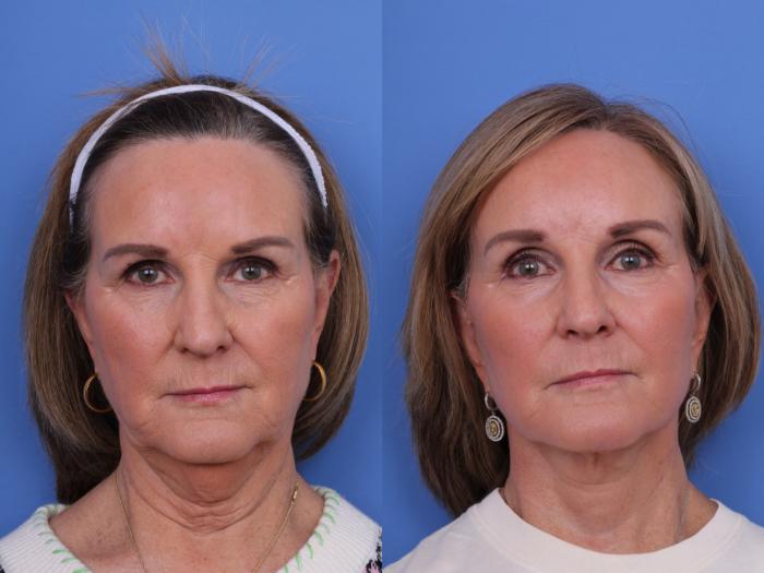 Before & After Brow Lift Case 673 Front View in Scottsdale, AZ