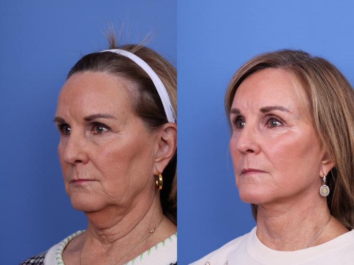 Before & After Brow Lift Case 673 Left Oblique View in Scottsdale, AZ