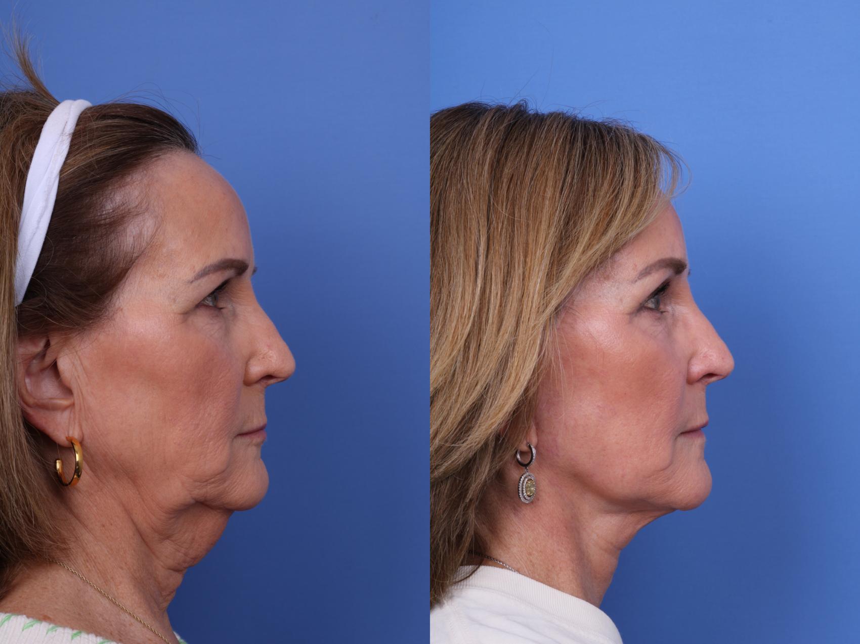 Before & After Brow Lift Case 673 Right Side View in Scottsdale, AZ