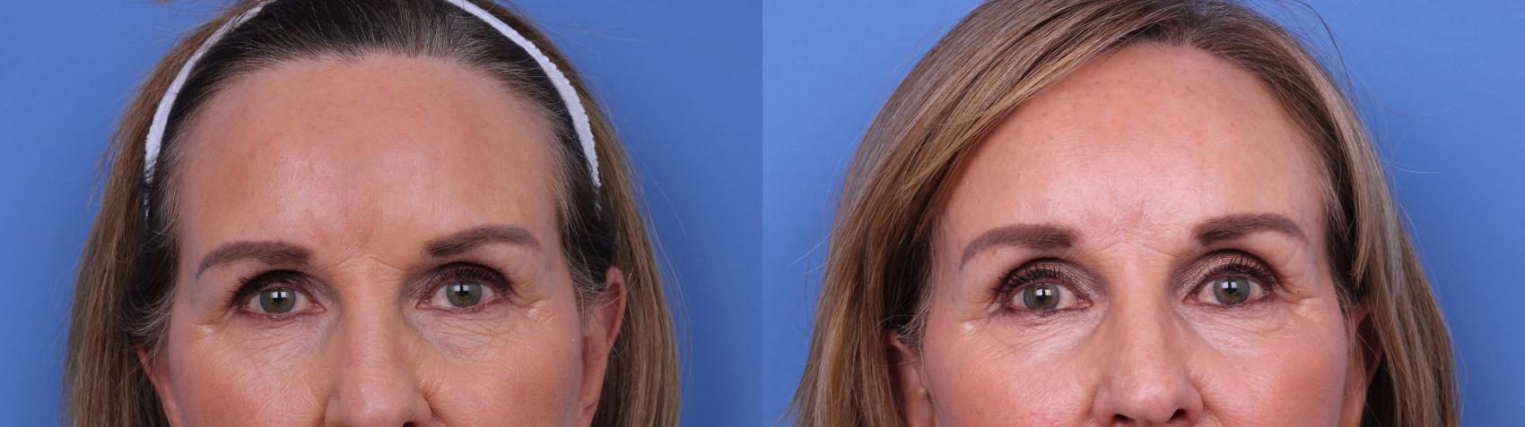 Before & After Brow Lift Case 673 Zoom Blepharoplasty View in Scottsdale, AZ