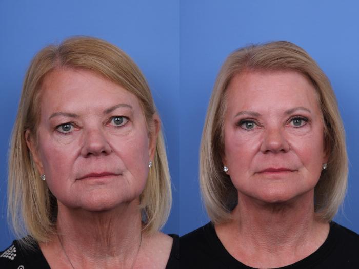 Before & After Facelift Case 674 Front View in Scottsdale, AZ