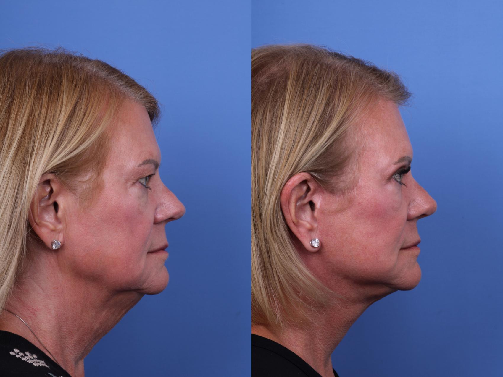 Before & After Facelift Case 674 Right Side View in Scottsdale, AZ