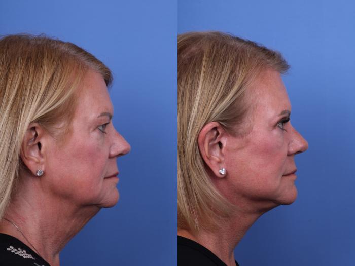 Before & After Facelift Case 674 Right Side View in Scottsdale, AZ