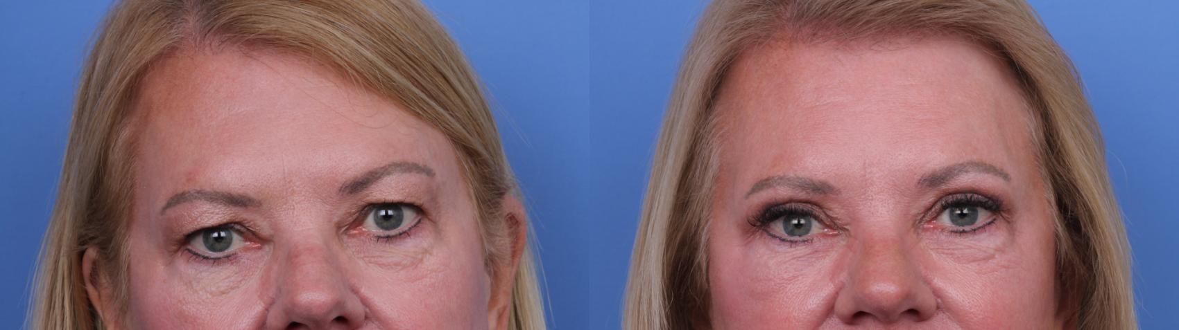 Before & After Facelift Case 674 Zoom Blepharoplasty View in Scottsdale, AZ