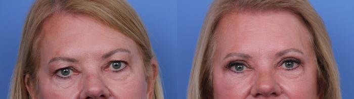 Before & After Facelift Case 674 Zoom Blepharoplasty View in Scottsdale, AZ