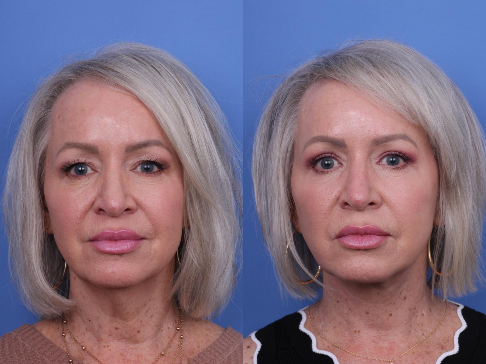 Before & After Facelift Case 678 Front View in Scottsdale, AZ