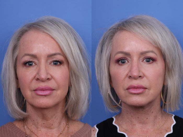 Before & After Facelift Case 678 Front View in Scottsdale, AZ