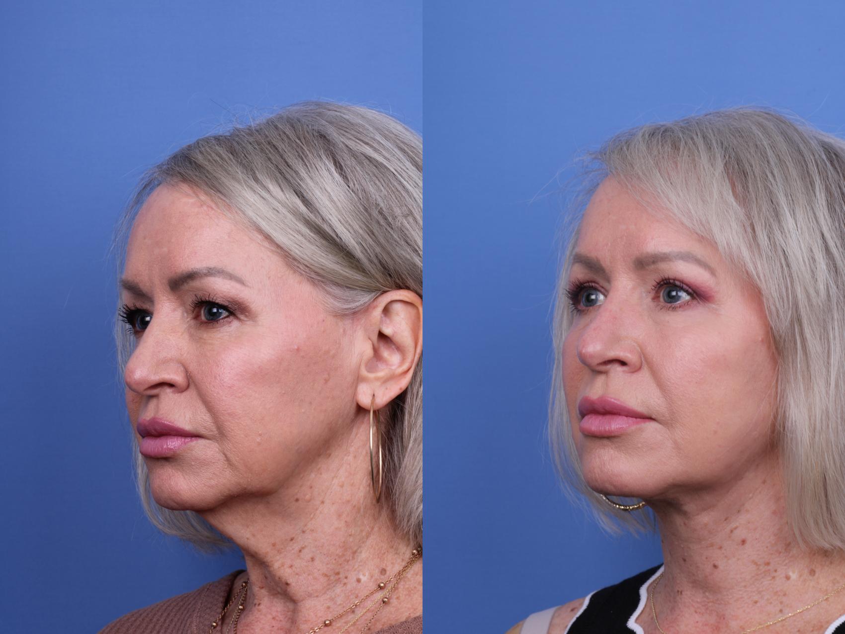 Before & After Facelift Case 678 Left Oblique View in Scottsdale, AZ