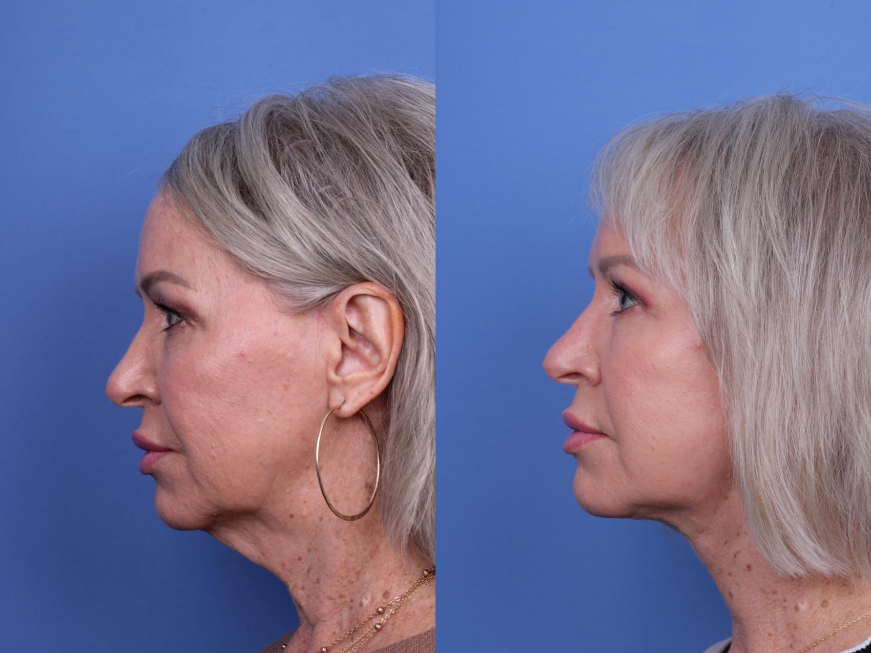 Before & After Facelift Case 678 Left Side View in Scottsdale, AZ