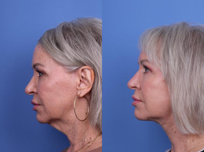 Before & After Facelift Case 678 Left Side View in Scottsdale, AZ