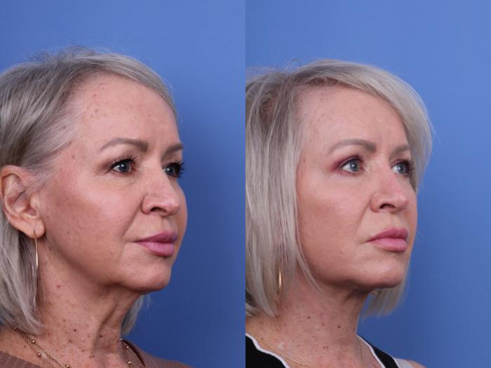 Before & After Facelift Case 678 Right Oblique View in Scottsdale, AZ