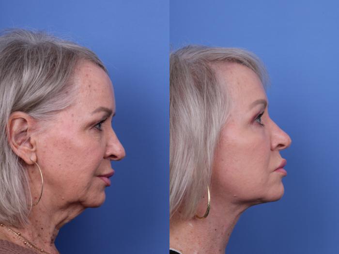 Before & After Facelift Case 678 Right Side View in Scottsdale, AZ