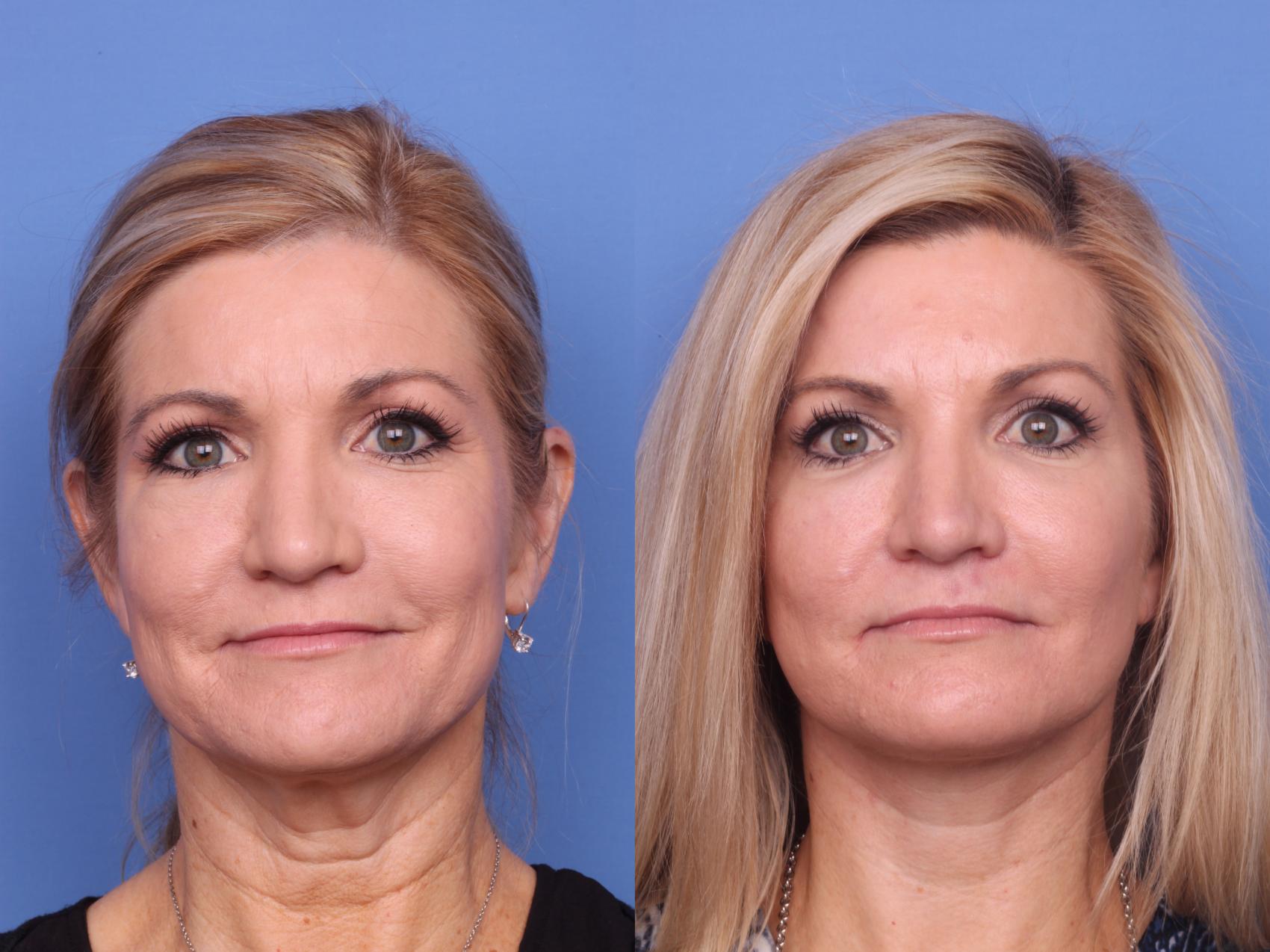 Before & After Submental Liposuction Case 687 Front View in Scottsdale, AZ