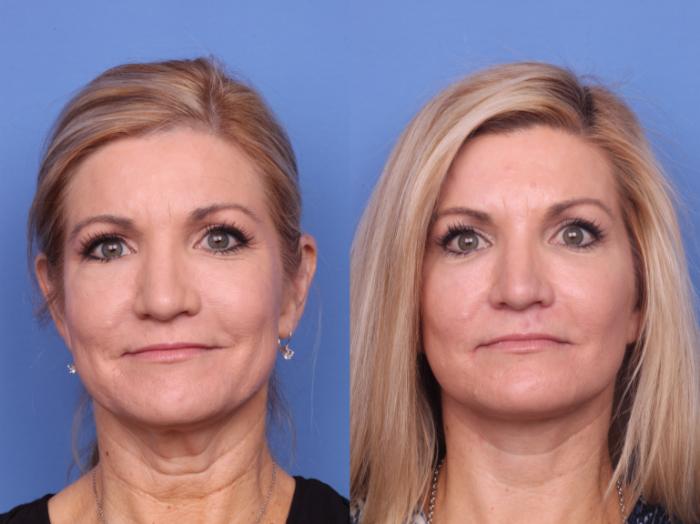 Before & After Submental Liposuction Case 687 Front View in Scottsdale, AZ