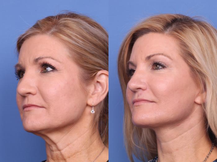 Before & After Submental Liposuction Case 687 Left Oblique View in Scottsdale, AZ