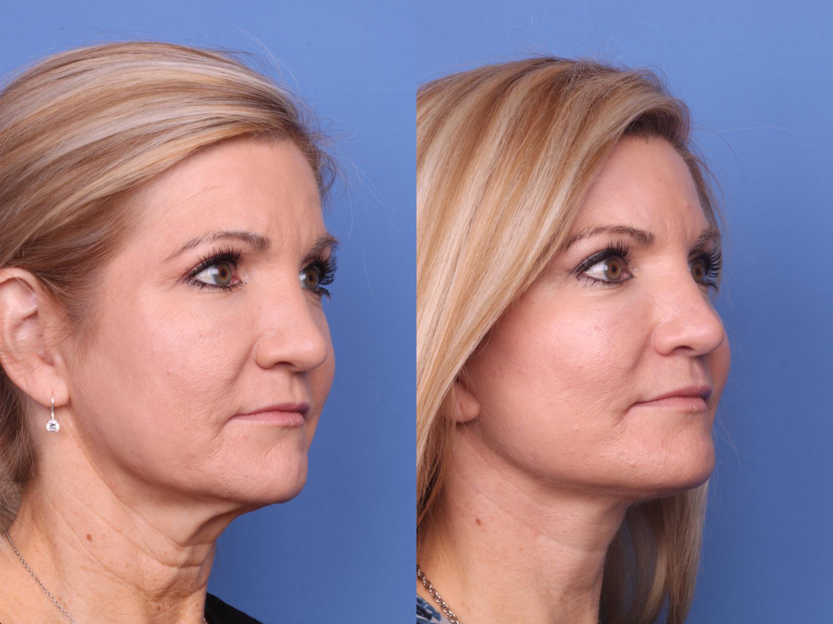 Before & After Submental Liposuction Case 687 Right Oblique View in Scottsdale, AZ