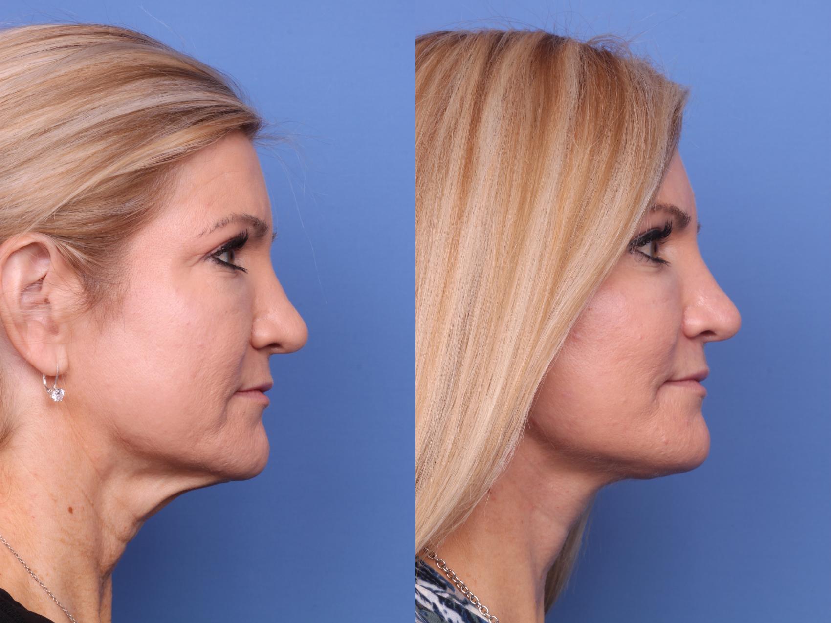 Before & After Submental Liposuction Case 687 Right Side View in Scottsdale, AZ