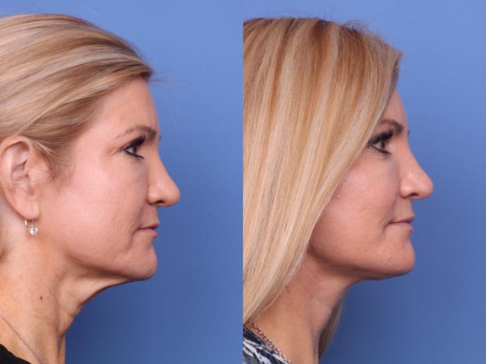 Before & After Submental Liposuction Case 687 Right Side View in Scottsdale, AZ